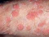 Signs And Symptoms Genital Warts Photos