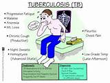 Photos of Tuberculosis Symptoms