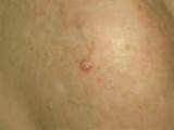 Images of Skin Cancer Types Squamous Pictures