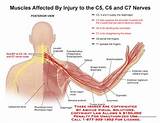 C5 C6 Nerve Damage Symptoms Photos