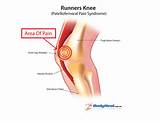Knee Injuries Symptoms Images