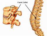 Facet Joint Arthritis Symptoms Photos