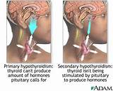Pituitary Gland Tumor Symptoms Images