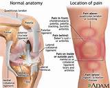 Symptoms Of Arthritis In Knee Cap Images