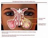 Photos of Symptoms Nasal Infection