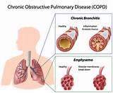 Images of Chronic Obstructive Pulmonary Disease Bronchitis