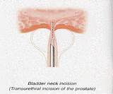Images of Bladder Neck Surgery