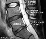Bulging Disc And Disability Images
