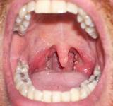 Symptoms Yeast Infection Mouth Photos