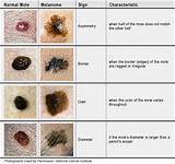 Types Of Skin Cancer Moles Photos