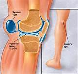 Images of Tumor Behind Knee Symptoms