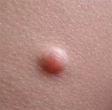 Picture Of Basal Cell Carcinoma Pictures