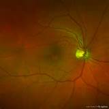 Pictures of Retinopathy Vs Macular Degeneration