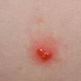Photos of Genital Warts And Throat Cancer