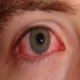 Chlamydia In Eyes Symptoms Images