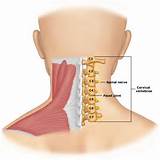 Exercises For Bulging Disc In Neck Pictures