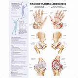 Arthritis Vs Fibromyalgia Symptoms Pictures