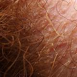 Scalp Infections Symptoms Photos