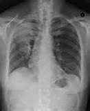 X Ray Of Chronic Bronchitis Pictures