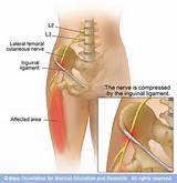 Lateral Femoral Cutaneous Nerve Damage Symptoms Photos