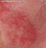 Pictures of Skin Rash Diagnosis