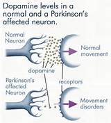 Parkinsons Dementia Pictures