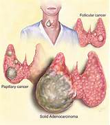Pictures of Thyroid Tumor Symptoms