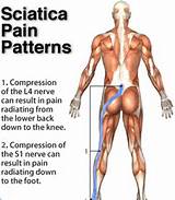 What Is Sciatic Nerve Pain Pictures