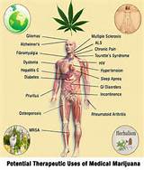 List Of Conditions For Medical Weed Photos