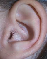 Symptoms Of Ear Infection Images