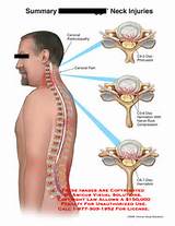 Pictures of C4 C5 Nerve Damage Symptoms