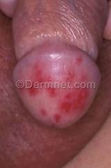 Photos of Symptoms Penile Yeast Infection