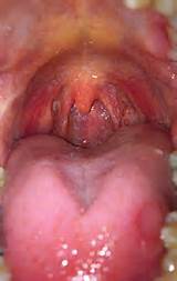 Throat Cancer Or Allergies Pictures