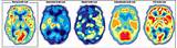 Bipolar Disorder Vs Schizophrenia Photos