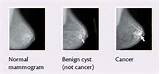 Photos of Breast Benign Cyst