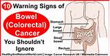 Pictures of Rectal Cancer Symptoms And Signs