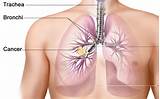 Symptoms Lung Tumor Pictures