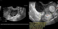 Ultrasound 5 Cm Ovarian Cyst