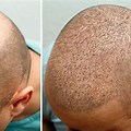 Before and After Hair Transplant Single Pic