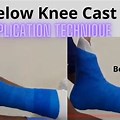 Below-Knee Cast 90 Degree Bracket