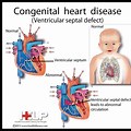 CHD Heart Disease