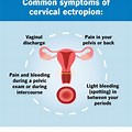 Cervical Ectropion Pregnancy Bleeding