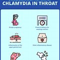 Chlamydia Throat Infection