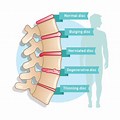 Degenerative Lumbar Spinal Stenosis Disease Treatment