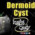 Dermoid Cyst Neck Ultrasound