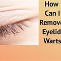 Eyelid Wart Removal Surgery