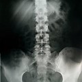 Herniated Disc X-ray Image