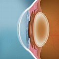 Implantable Collamer Lens CPT