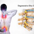 Lumbar Spinal Cord Degeneration