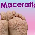 Maceration Skin Wound